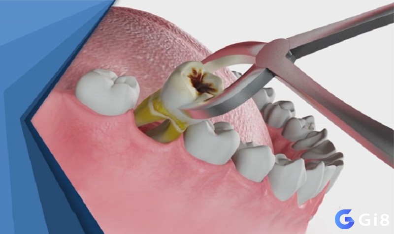 Mơ thấy nhổ răng là dấu hiệu của sự giải thoát khỏi những điều tiêu cực trong cuộc sống